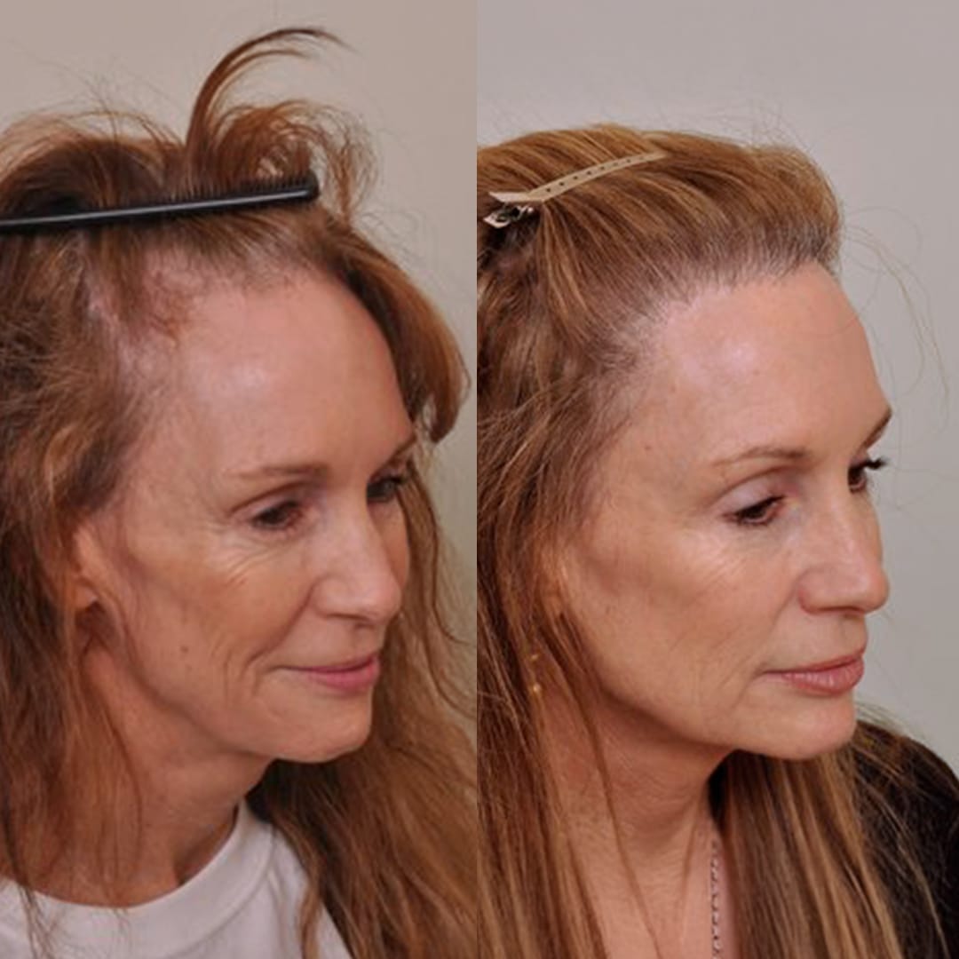 The Ultimate Hair Transplant Guide for Beginners