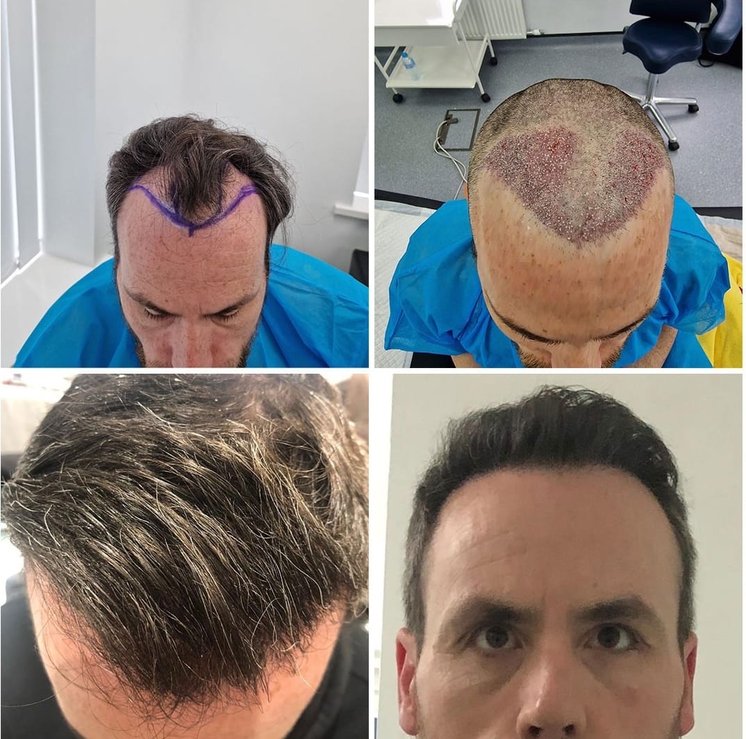 Hair Transplant UK – Restore Your Hair with Leading Surgeons