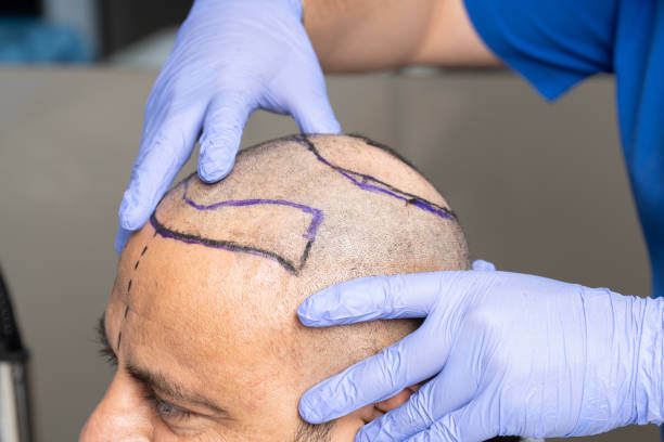 How Much Is Hair Transplant: Budget Guide for Patients