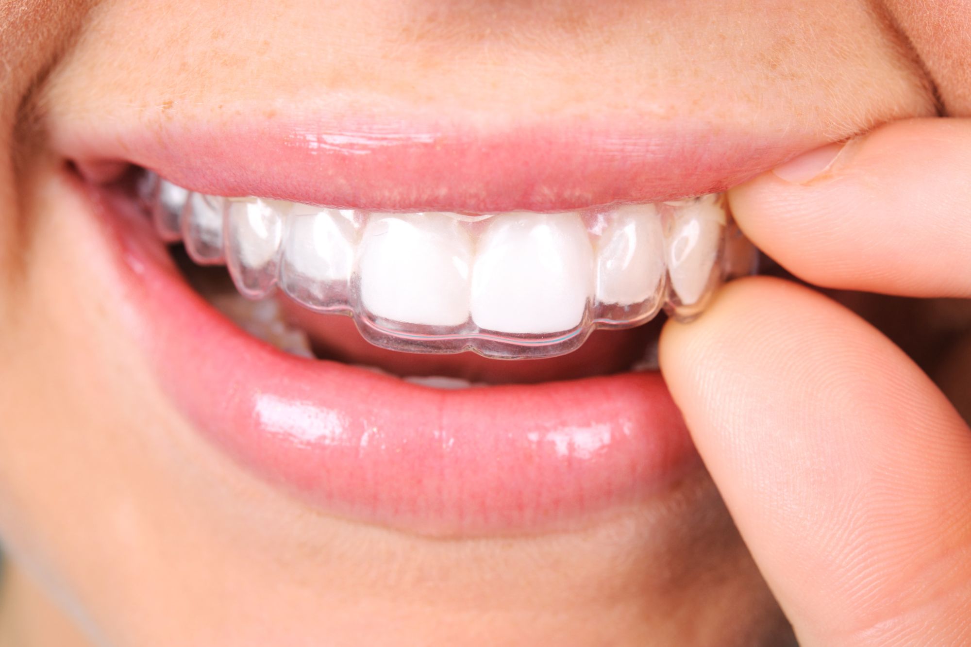 Ceramic Braces vs Metal Braces: Which Is Better for You?
